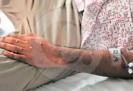 mpox_50407410_20260418213545