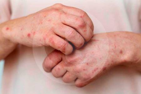 mpox-1-1_50520981_20260501131138